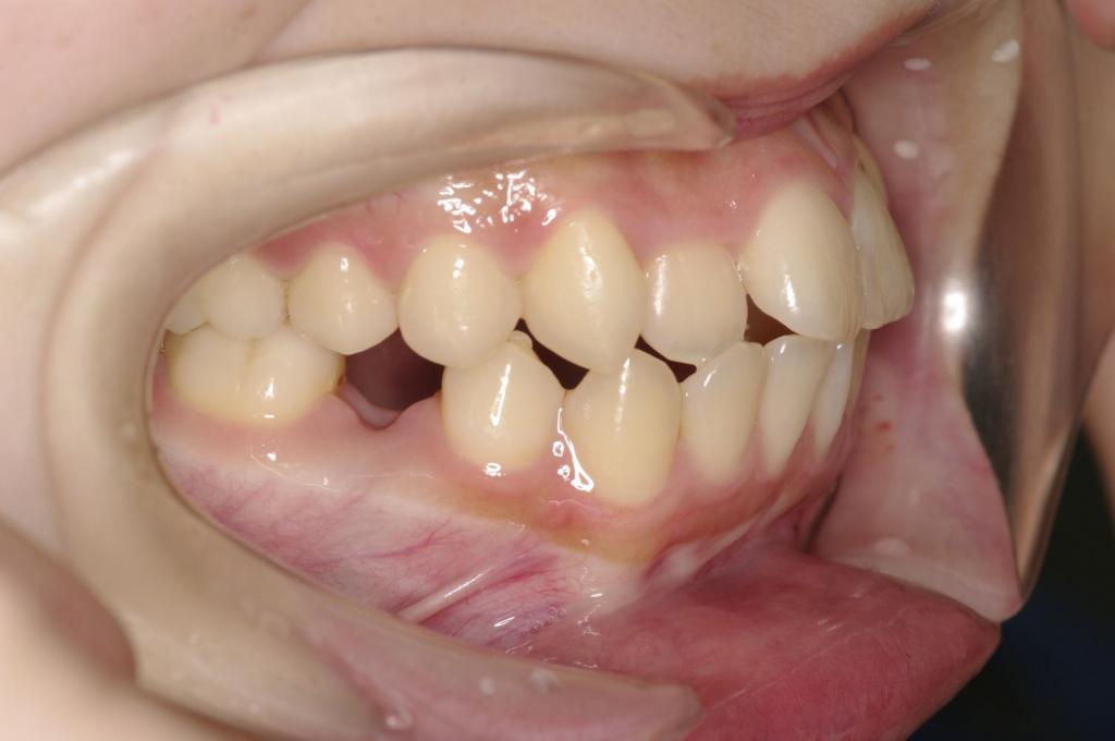 歯欠損の矯正治療前口内写真NO.130