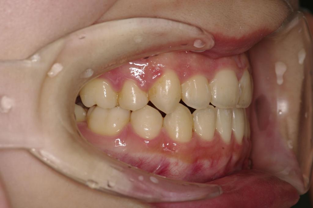 歯欠損の矯正治療後口内写真NO.130