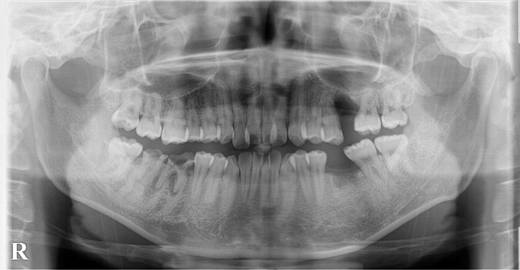 歯欠損の矯正治療前口内写真NO.131
