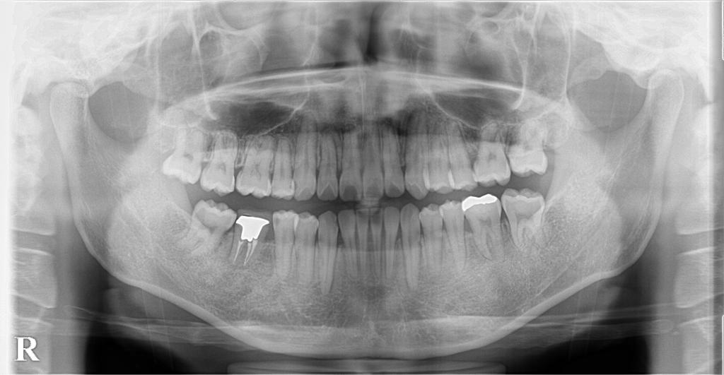 歯欠損の矯正治療後口内写真NO.131