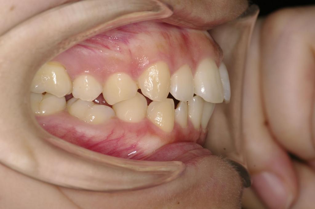 歯欠損の矯正治療前口内写真NO.146