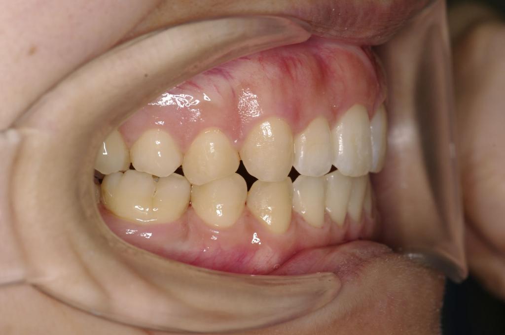 歯欠損の矯正治療後口内写真NO.146
