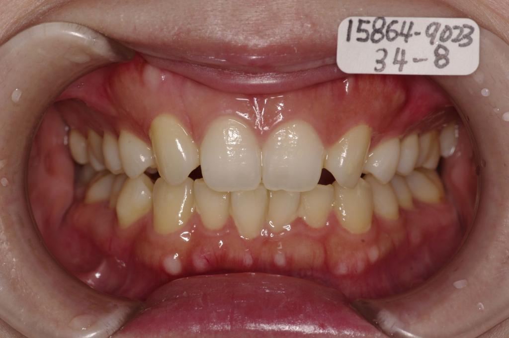 歯欠損の矯正治療前口内写真NO.147