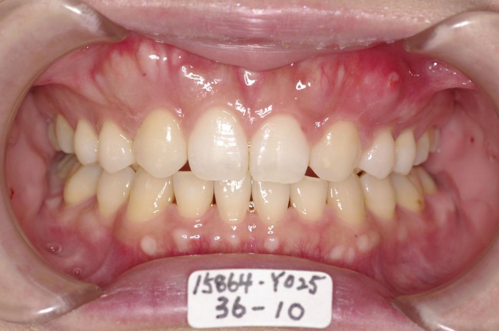 歯欠損の矯正治療後口内写真NO.147