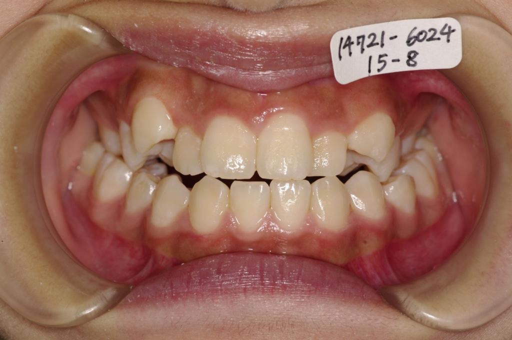 歯欠損の矯正治療前口内写真NO.148