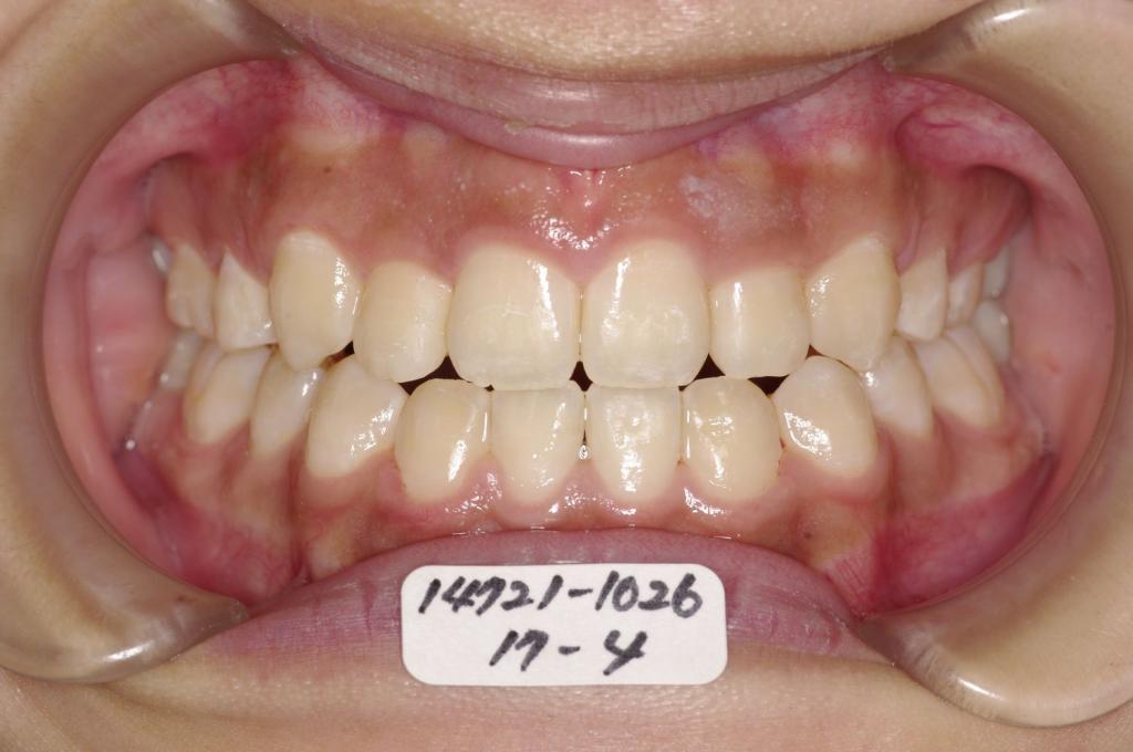 歯欠損の矯正治療後口内写真NO.148
