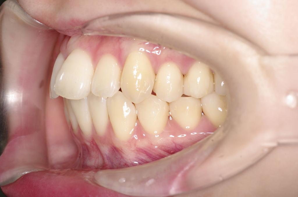 歯欠損の矯正治療前口内写真NO.149