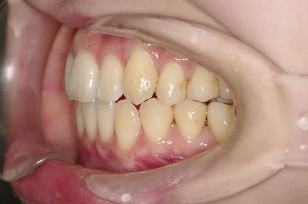 歯欠損の矯正治療後口内写真NO.149