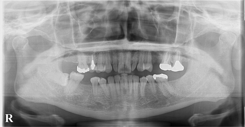 歯欠損の矯正治療前口内写真NO.150