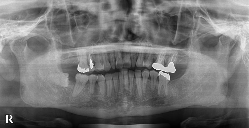 歯欠損の矯正治療後口内写真NO.150