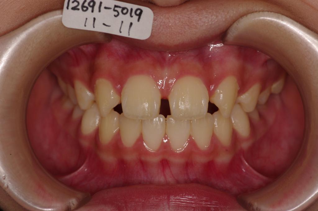 歯欠損の矯正治療前口内写真NO.99