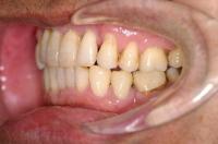 歯周病を伴った矯正治療後口内写真NO.1