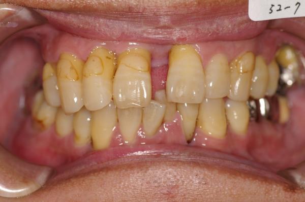 歯周病を伴った矯正治療前口内写真NO.12