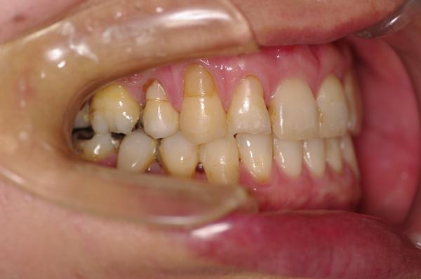 歯周病を伴った矯正治療後口内写真NO.16