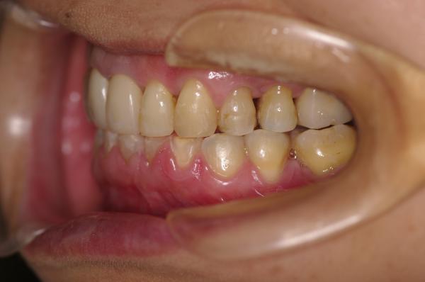 歯周病を伴った矯正治療後口内写真NO.17