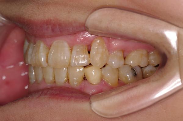 歯周病を伴った矯正治療後口内写真NO.18