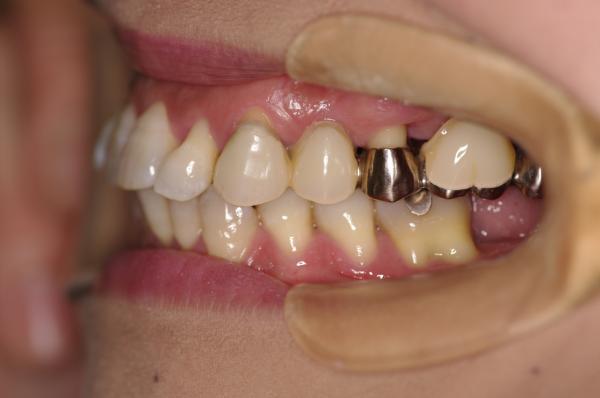 歯周病を伴った矯正治療前口内写真NO.19