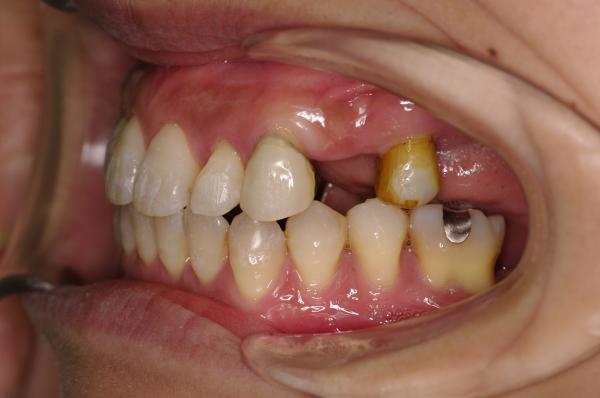 歯周病を伴った矯正治療後口内写真NO.19