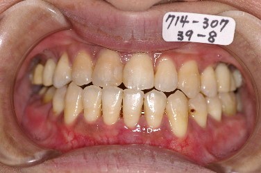 歯周病を伴った矯正治療後口内写真NO.2