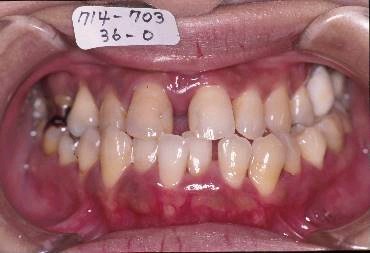 歯周病を伴った矯正治療前口内写真NO.2