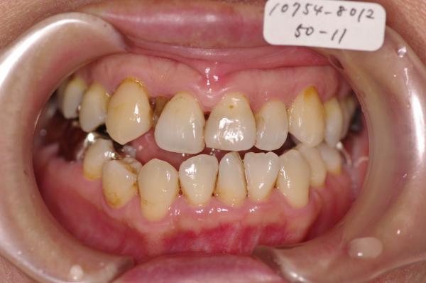 歯周病を伴った矯正治療前口内写真NO.20