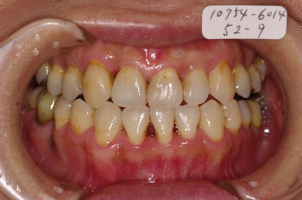 歯周病を伴った矯正治療後口内写真NO.20