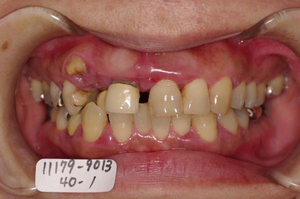 歯周病を伴った矯正治療前口内写真NO.21