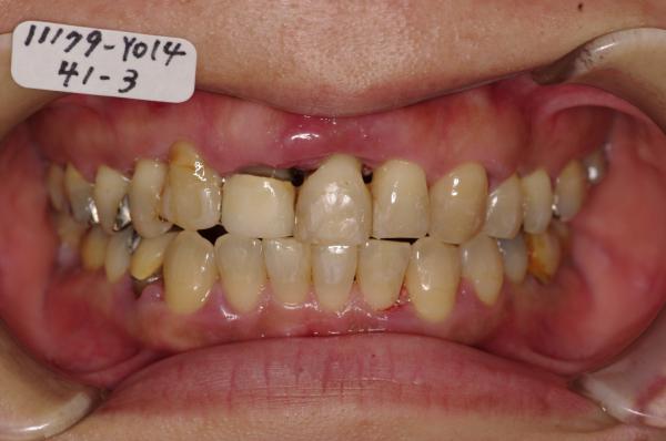 歯周病を伴った矯正治療後口内写真NO.21