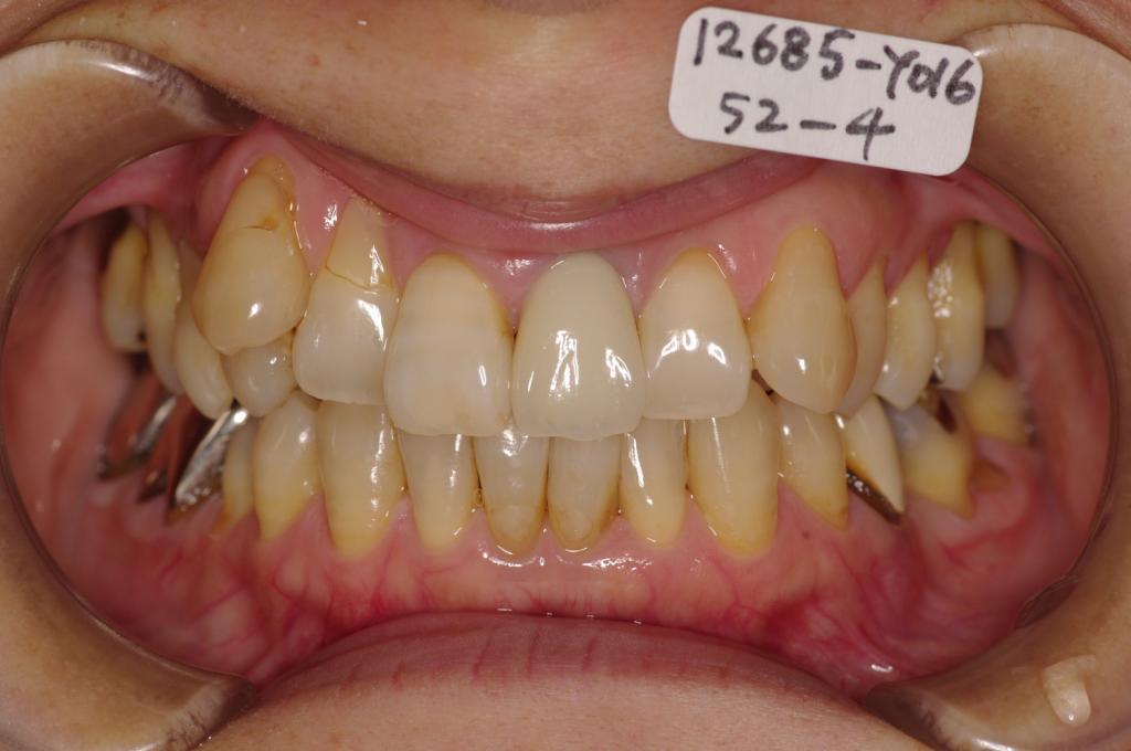 歯周病を伴った矯正治療前口内写真NO.22