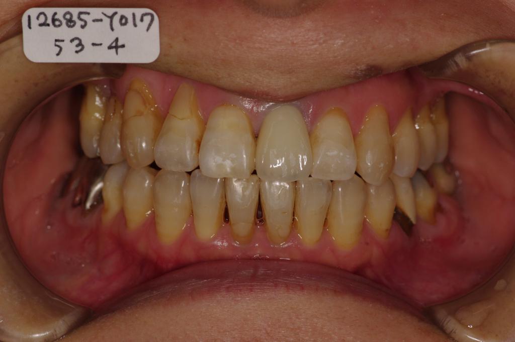 歯周病を伴った矯正治療後口内写真NO.22