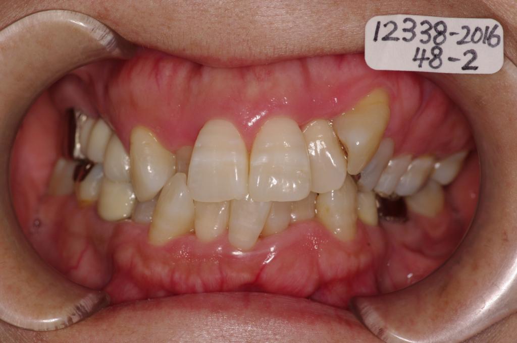 歯周病を伴った矯正治療前口内写真NO.23