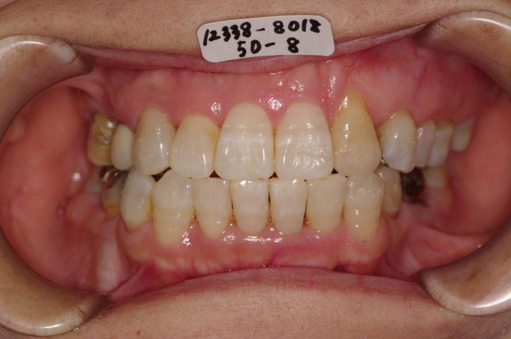歯周病を伴った矯正治療後口内写真NO.23