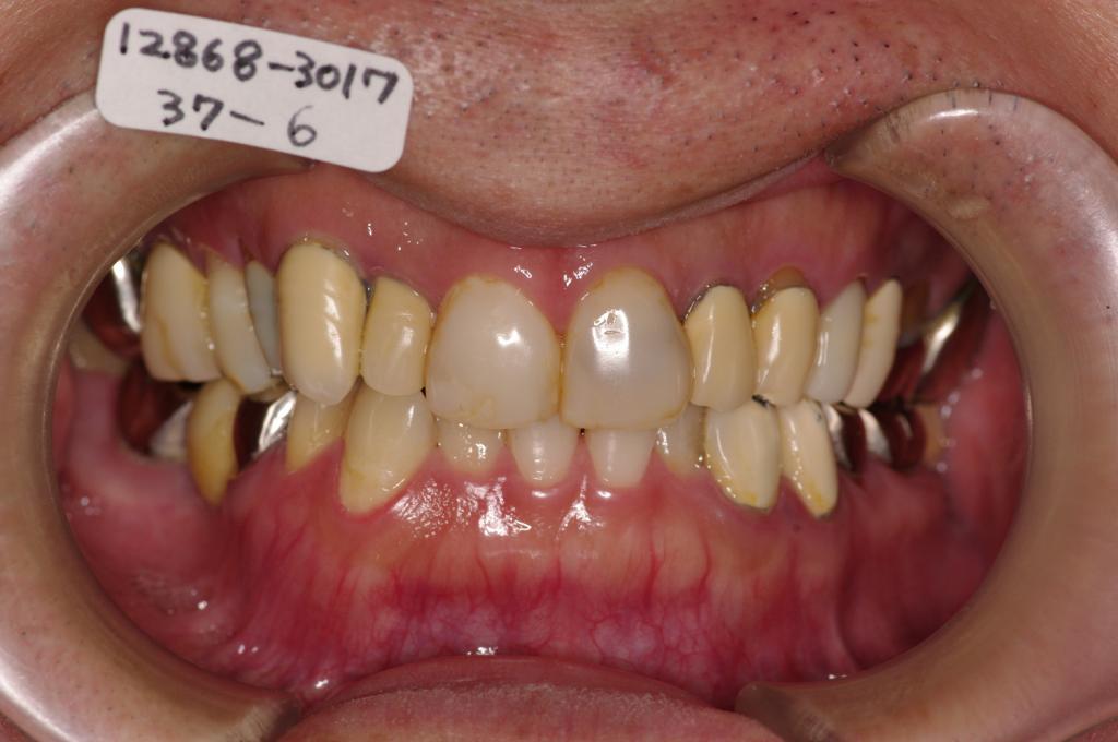 歯周病を伴った矯正治療前口内写真NO.24