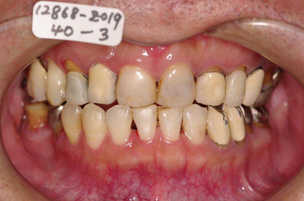 歯周病を伴った矯正治療後口内写真NO.24