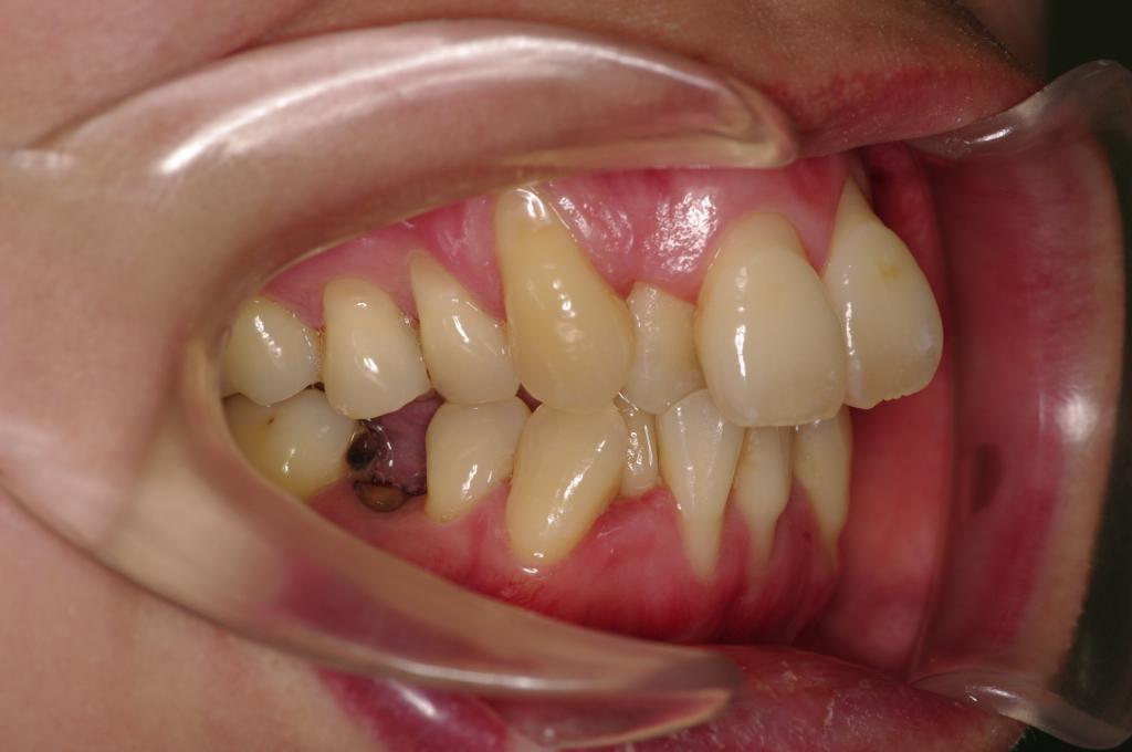 歯周病を伴った矯正治療前口内写真NO.25