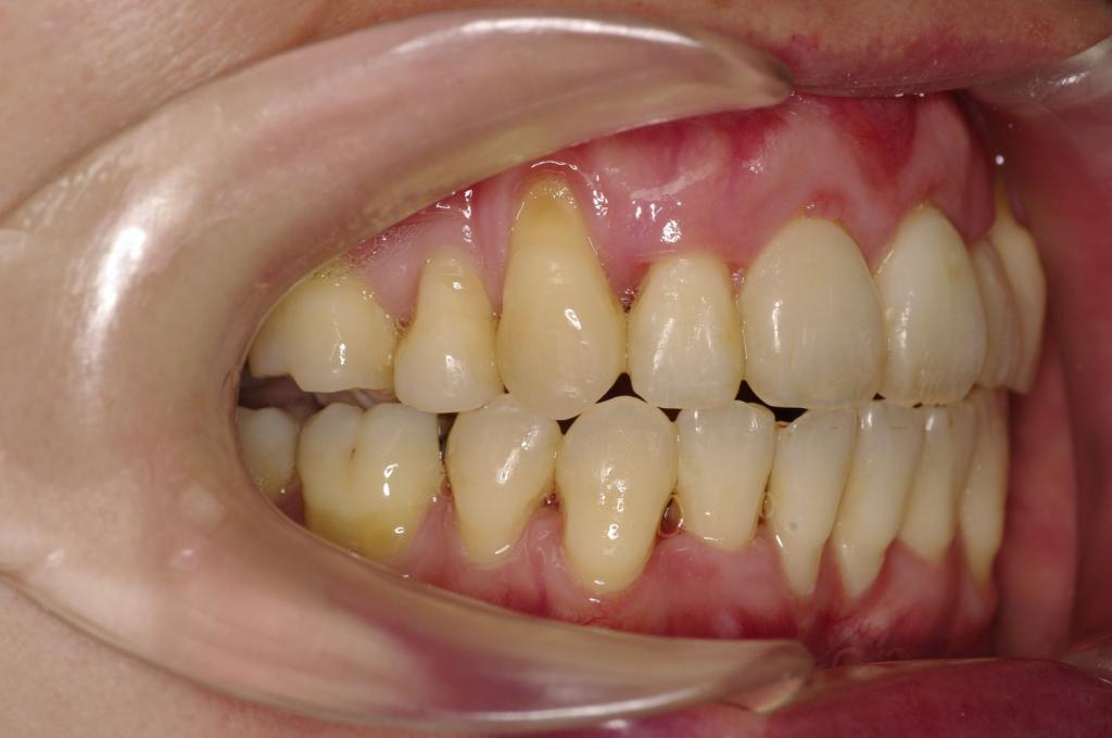 歯周病を伴った矯正治療後口内写真NO.25
