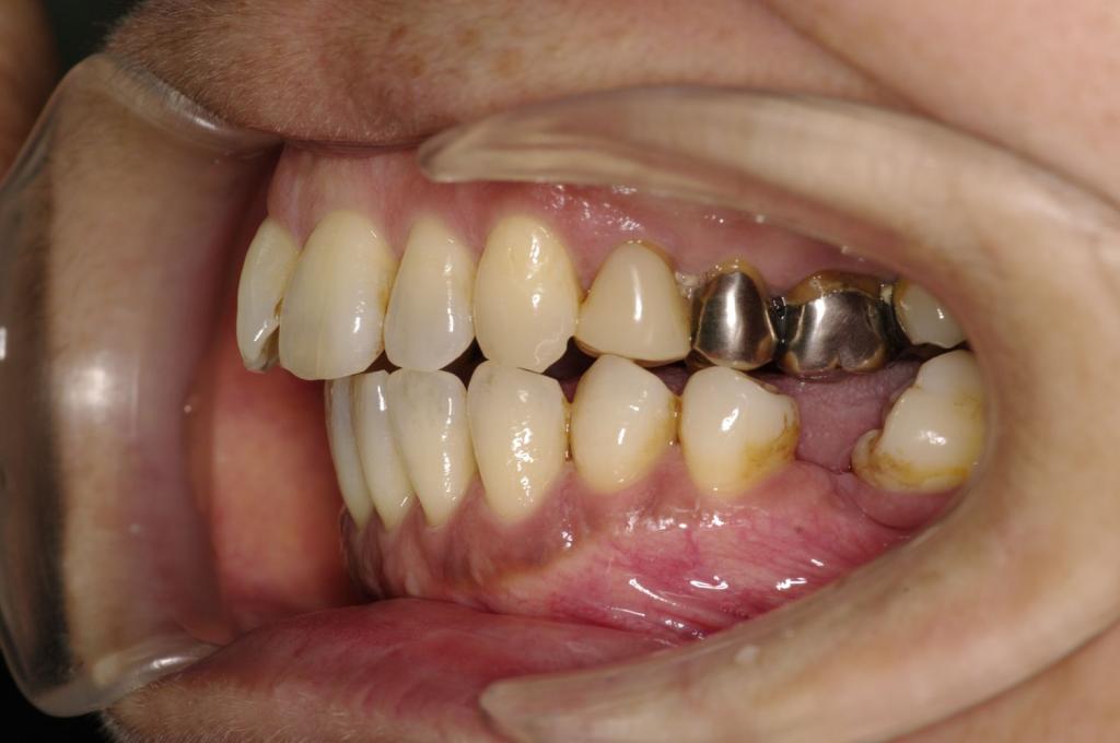 歯周病を伴った矯正治療前口内写真NO.28