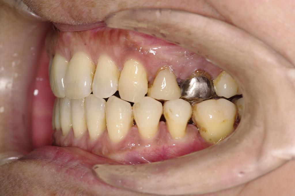 歯周病を伴った矯正治療後口内写真NO.28