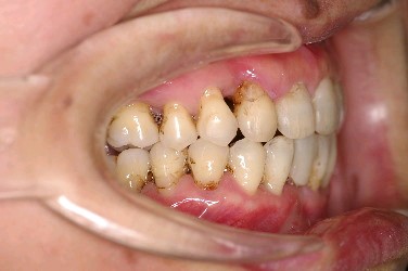 歯周病を伴った矯正治療後口内写真NO.4