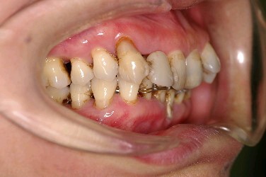 歯周病を伴った矯正治療前口内写真NO.4