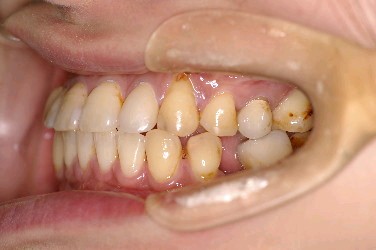 歯周病を伴った矯正治療後口内写真NO.5