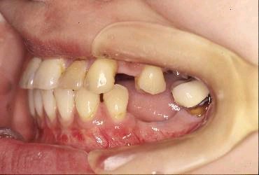 歯周病を伴った矯正治療前口内写真NO.5