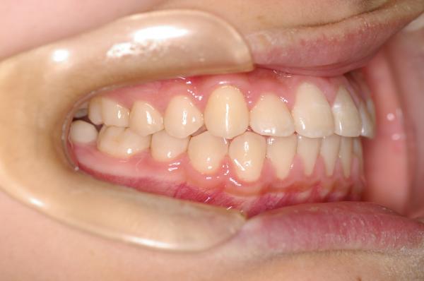 埋伏歯の矯正治療後口内写真NO.10