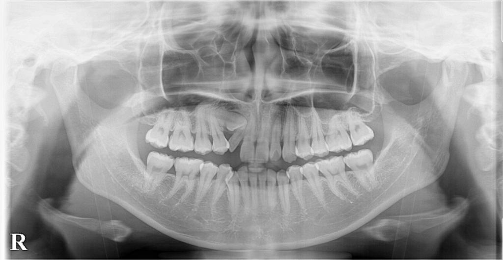 埋伏歯の矯正治療前口内写真NO.23