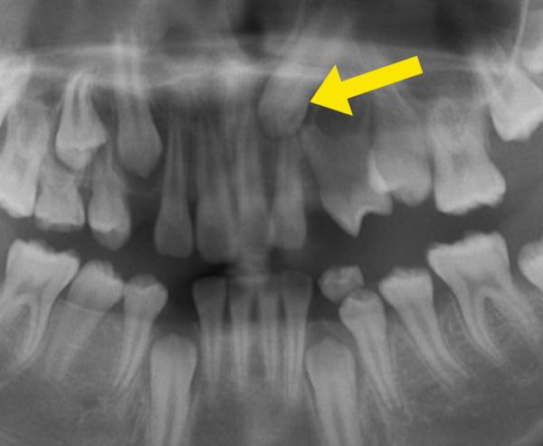 埋伏歯の矯正治療前口内写真NO.9