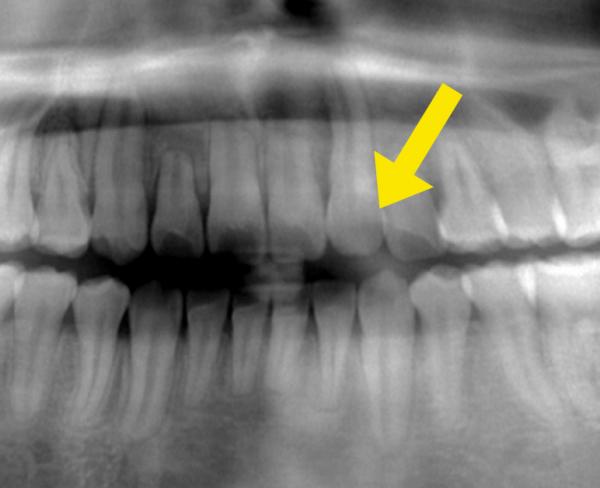 埋伏歯の矯正治療後口内写真NO.9