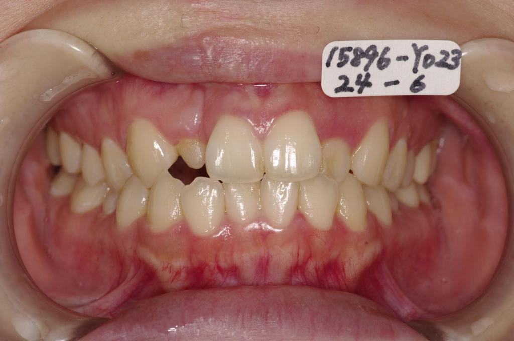 矯正治療前口内写真NO.84