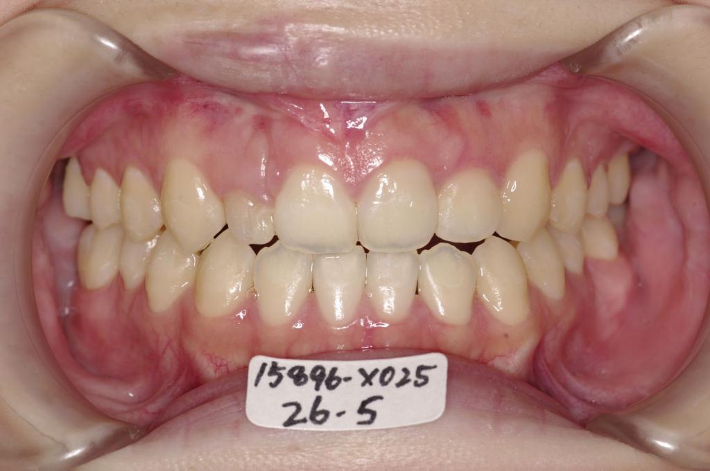 矯正治療後口内写真NO.84